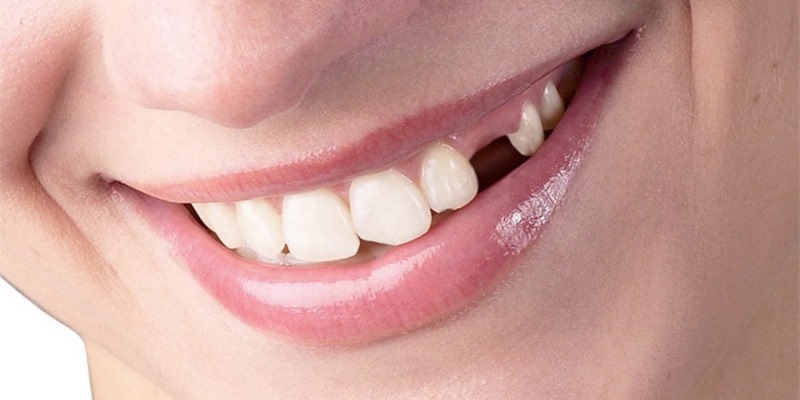 Tìm hiểu ý nghĩa của giấc mơ thấy răng rụng